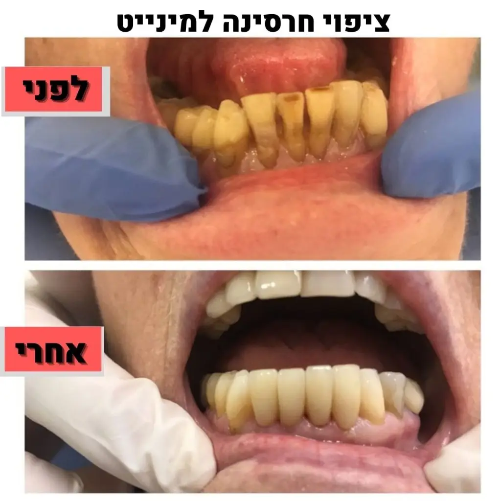 ציפוי חרסינה למינייט ד"ר זילברשר