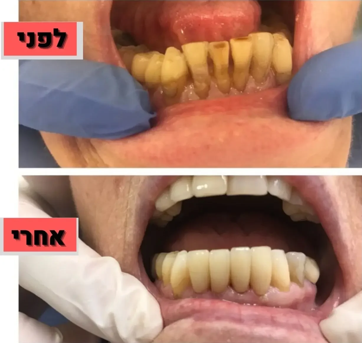 ציפוי חרסינה למינייט ד"ר זילברשר