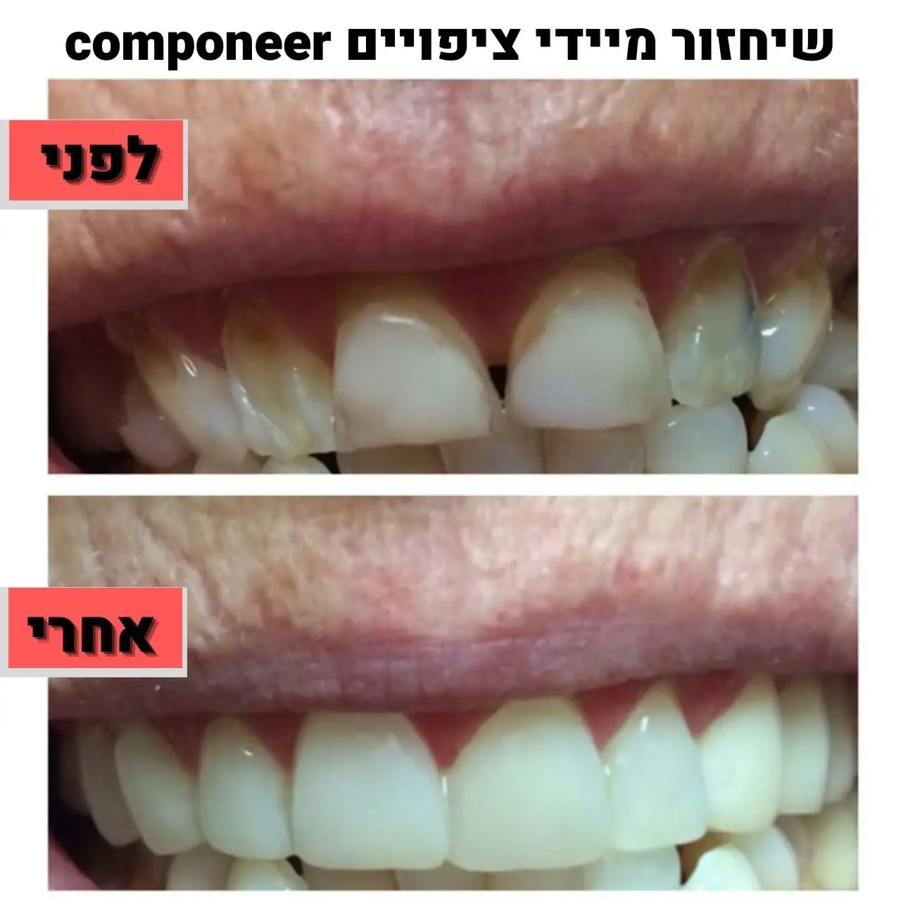 שיחזור מיידי ציפויים componeer ד"ר זילברשר