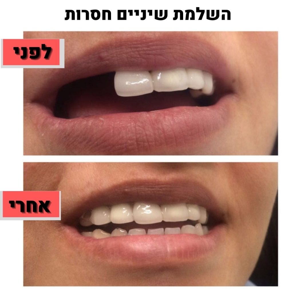 השלמת שיניים חסרות | ד"ר זילברשר