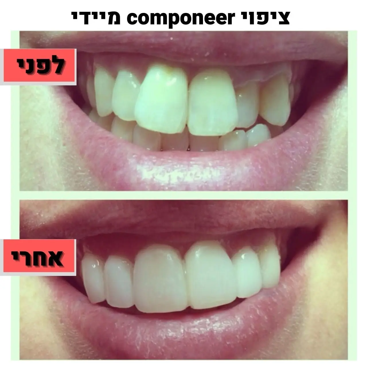 ציפוי componeer מיידי | ד"ר זילברשר
