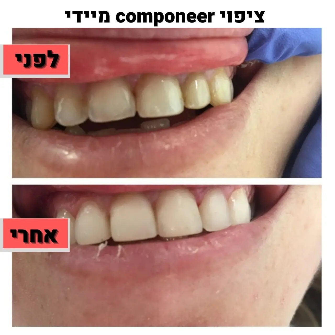 שיחזורי קומפוזיט - לפני ואחרי | ד"ר זילברשר