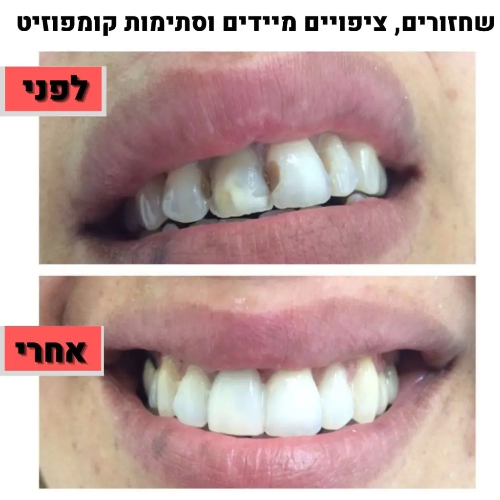 ד"ר זילברשר | שיחזורים - ציפויים מיידים וסתימות קומפוזיט - לפני ואחרי