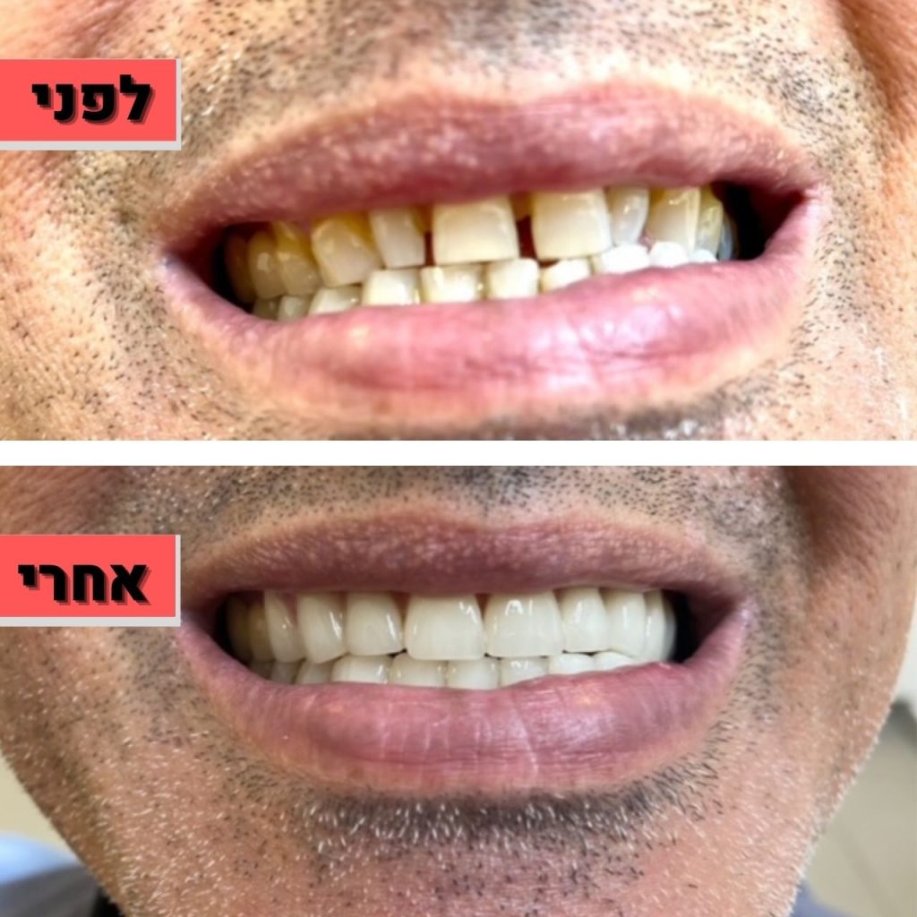 ציפוי חרסינה למינייט לשיניים | ד"ר זילברשר