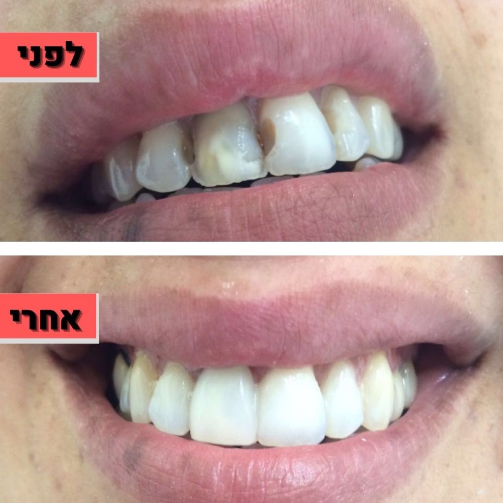 ציפוי למינייט לשיניים | מרפאת ד"ר זילברשר
