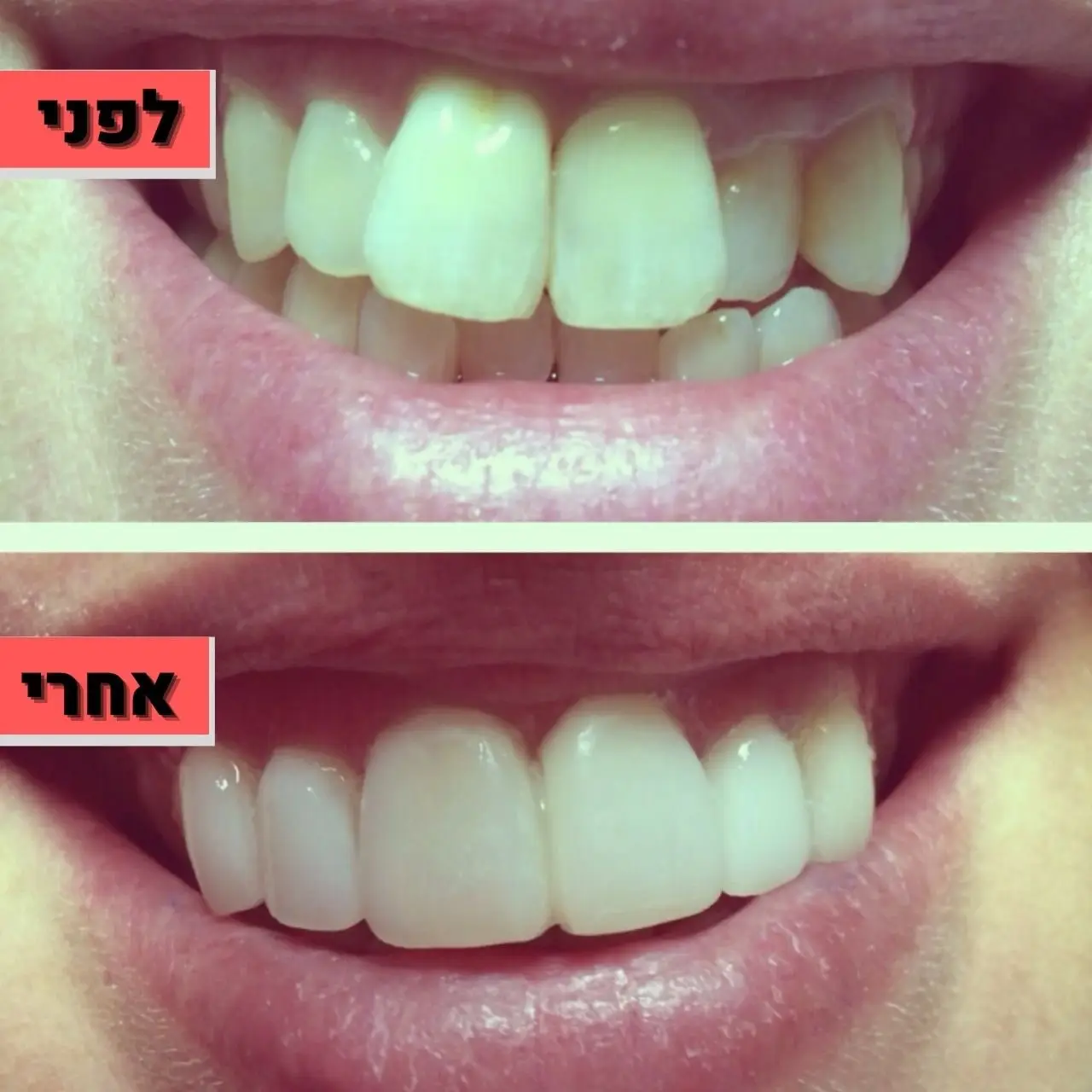 ציפוי למינייט לפגמים בצבע השן