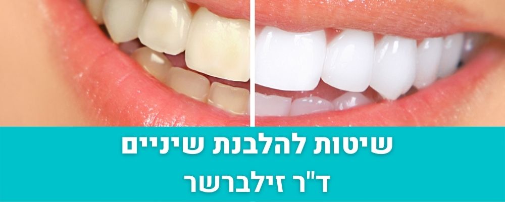 שיטות להלבנת שיניים 