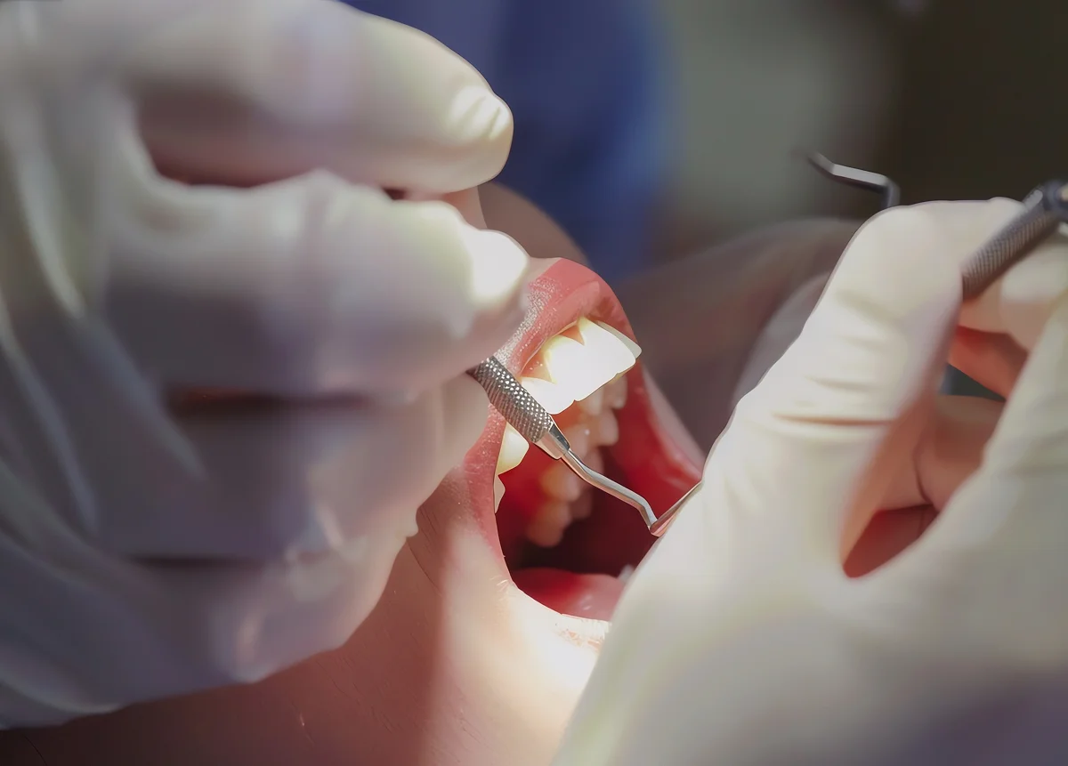 עקירת שיני בינה