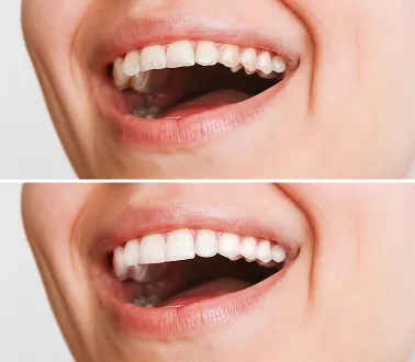 ציפוי למינייט