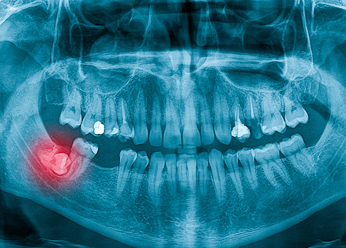 שן בינה כלואה