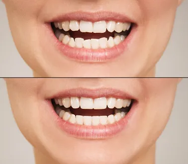 שתלים דנטליים